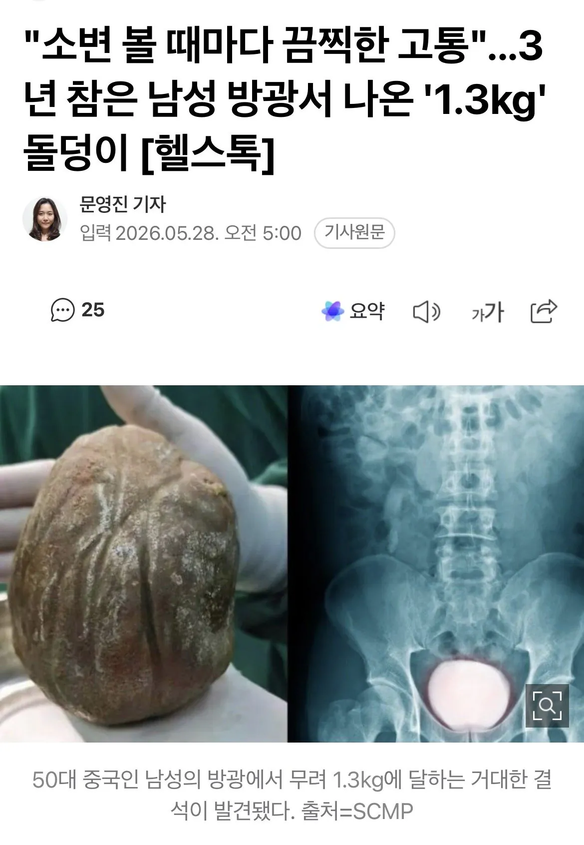 방광에서 1.3kg 결석 나온 남성 레전드